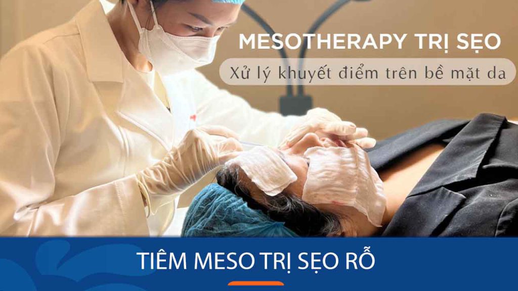 Tiêm meso trị sẹo rỗ: Giải pháp hoàn hảo cho làn da mịn màng
