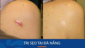 Tìm địa chỉ trị sẹo tốt nhất tại Đà Nẵng: Công nghệ tiên tiến, chi phí hợp lý