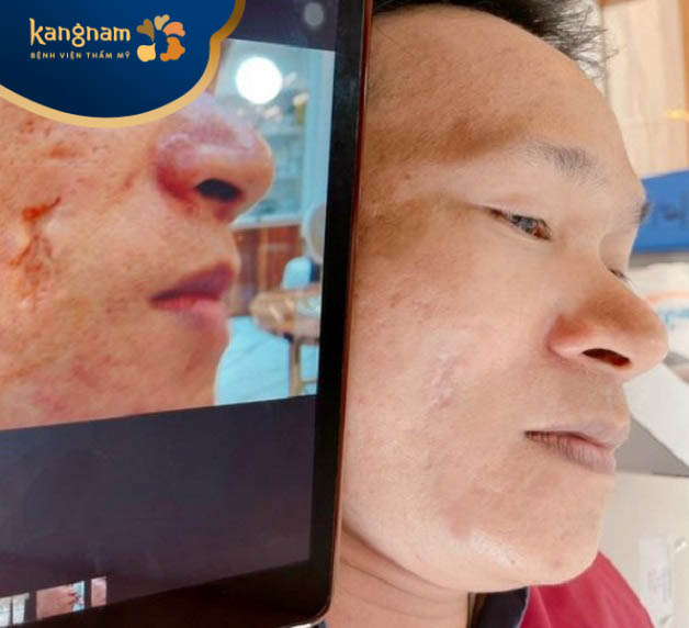 Anh Quang Tuấn sau trị sẹo tại Kangnam Nghệ An đã feedback