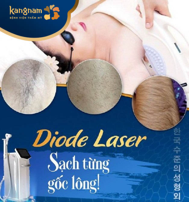 Công nghệ triệt lông Diode Laser