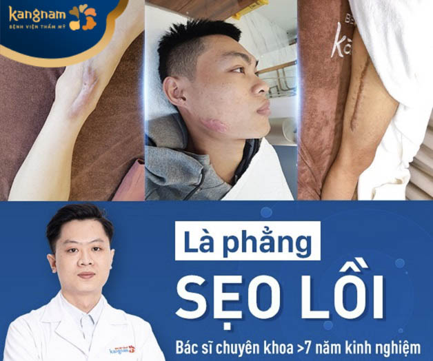 Điều trị sẹo lồi tại viện thẩm mỹ Kangnam Cần Thơ