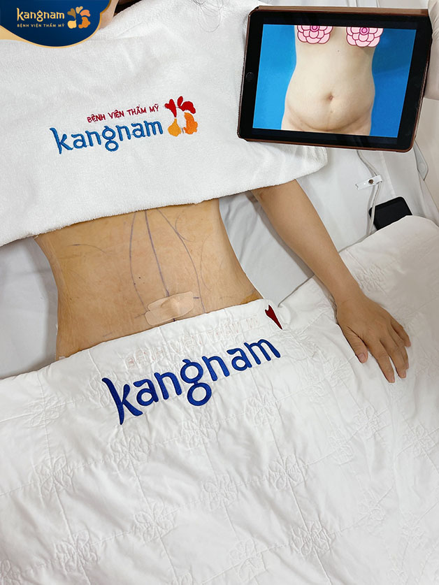 Giảm mỡ tại Kangnam