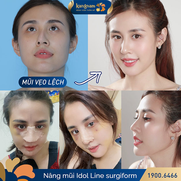 Các khuyết điểm ở mũi được cải thiện sau khi sử dụng dịch vụ tại Kangnam 