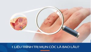 1 Liệu trình trị mụn cóc là bao lâu? Giải đáp chi tiết từ chuyên gia