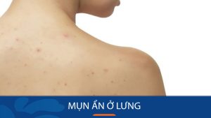 Mụn ẩn ở lưng – Nguyên nhân, ảnh hưởng và cách trị hiệu quả