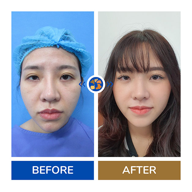 Trước và sau khi nâng mũi tại Kangnam, thay đổi nhan sắc vượt bậc