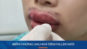 Cảnh báo: Những biến chứng nghiêm trọng sau khi tiêm filler môi