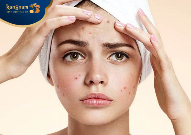 Chăm sóc da mụn đúng cách sẽ giúp cho các nốt mụn giảm tình trạng sưng đỏ, hạn chế viêm tấy