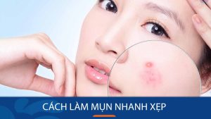 Bật Mí 11 Cách Xử Lý Mụn Sưng Viêm Nhanh Chóng Không Để Lại Sẹo