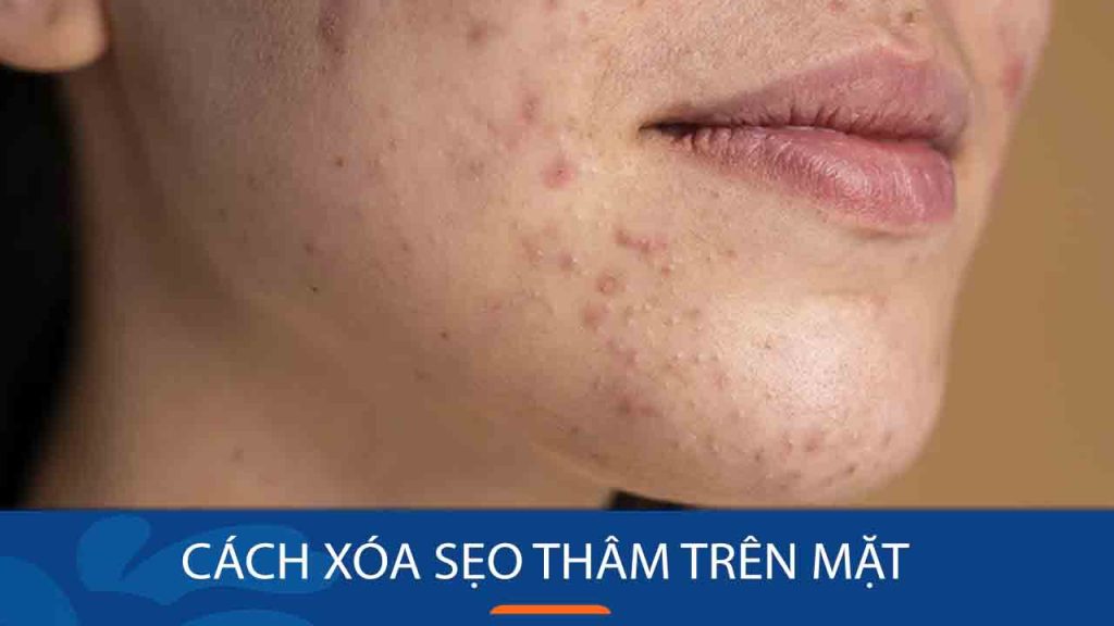 Cách xóa sẹo thâm trên mặt : Bí quyết xóa sẹo thâm trên mặt hiệu quả tại nhà