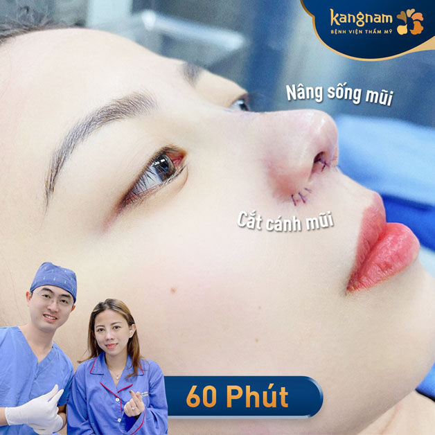 Khách hàng cắt cánh mũi kết hợp nâng sống mũi tại Kangnam