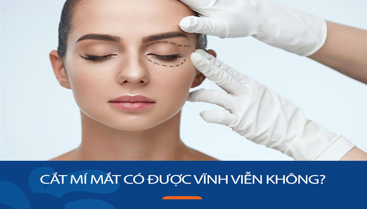 Cắt mí mắt có được vĩnh viễn không? Bí quyết giữ gìn
