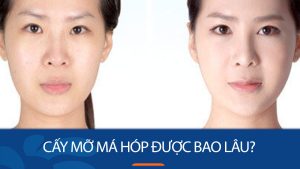 Cấy mỡ má hóp được bao lâu? Những ưu điểm thường thấy