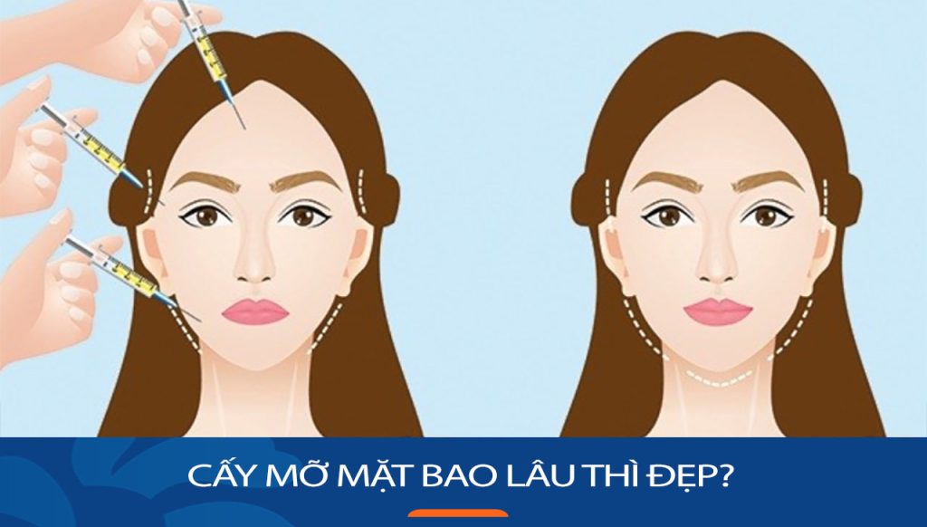 Cấy mỡ mặt bao lâu thì đẹp? Những lưu ý cần nhớ sau khi cấy mỡ