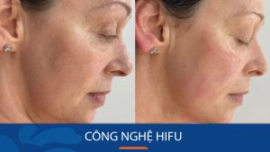 Công nghệ Hifu là gì? Có tác dụng ra sao? Ưu và nhược điểm