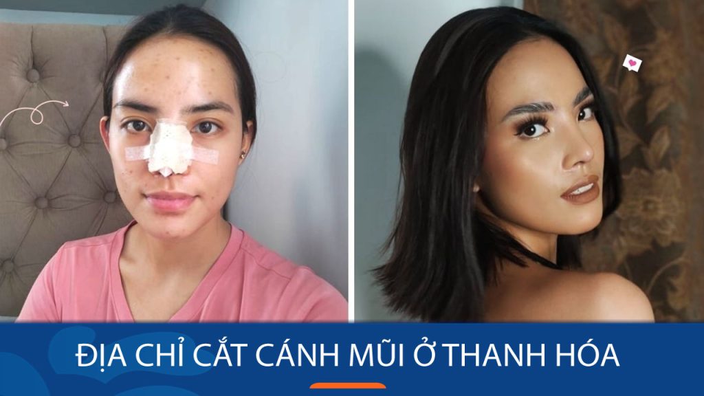 Địa chỉ cắt cánh mũi ở Thanh Hóa – Mũi thon gọn, đẹp tự nhiên
