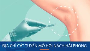 Địa chỉ cắt tuyến mồ hôi nách ở Hải Phòng uy tín, hiệu quả