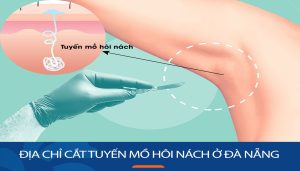 Địa chỉ cắt tuyến mồ hôi nách ở Đà Nẵng hiệu quả