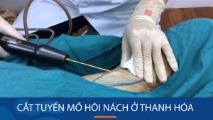 Địa chỉ cắt tuyến mồ hôi nách ở Thanh Hóa uy tín, chuyên nghiệp