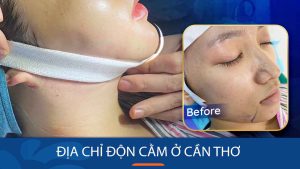 Địa chỉ độn cằm ở Cần Thơ Uy Tín – Chất lượng