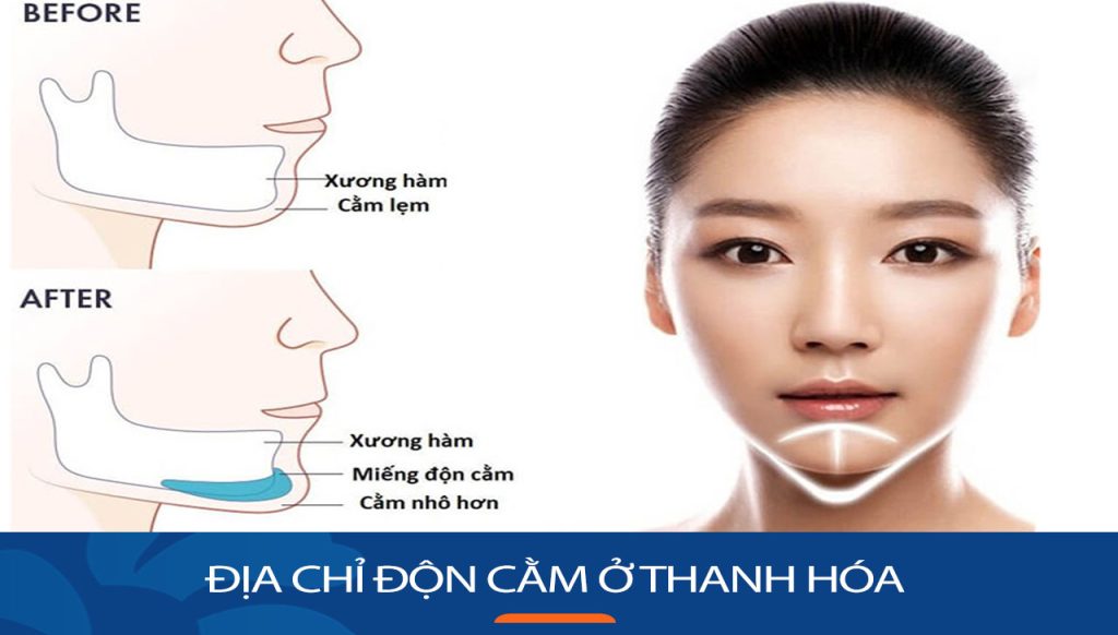 Địa chỉ độn cằm ở Thanh Hóa đẹp vĩnh viễn