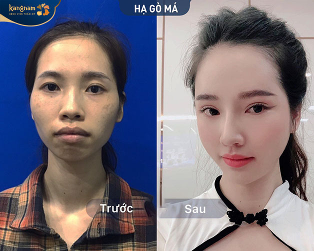 Hình ảnh khách hàng trước và sau khi hạ gò má tại Kangnam 