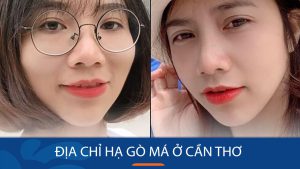 Địa chỉ hạ gò má ở Cần Thơ chuẩn Y khoa nhất hiện nay