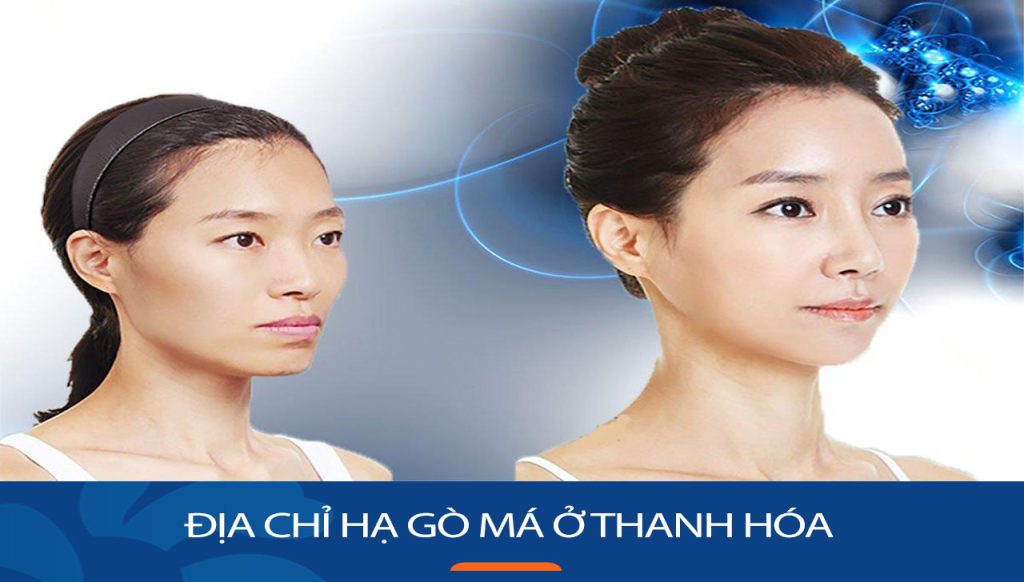 Địa chỉ hạ gò má ở Thanh Hóa tốt nhất – Uy tín nhất