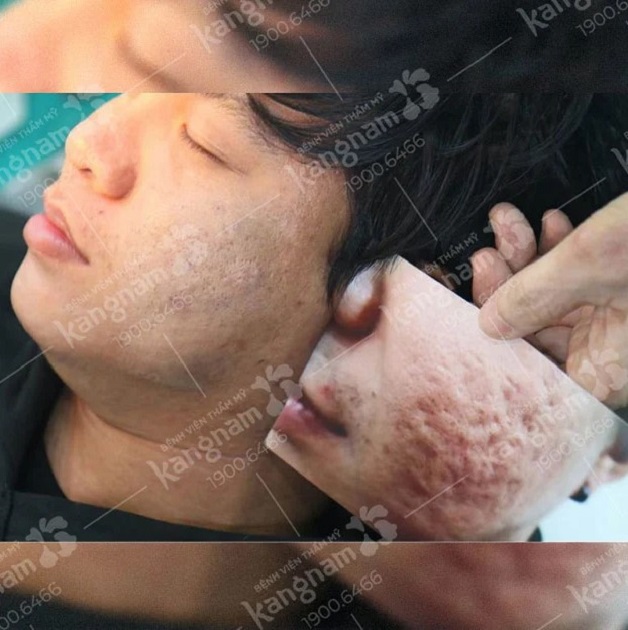 Kết quả trị sẹo rỗ tại Kangnam