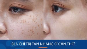 Kangnam – Địa chỉ trị tàn nhang ở Cần Thơ Uy Tín