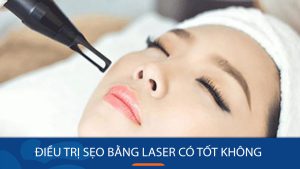Điều trị sẹo rỗ bằng laser có tốt không? có tác dụng phụ không