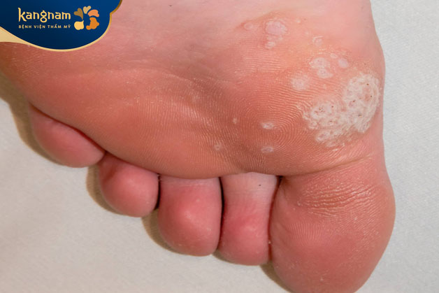 Mụn cóc phát triển rộng trên vùng da ở lòng bàn chân