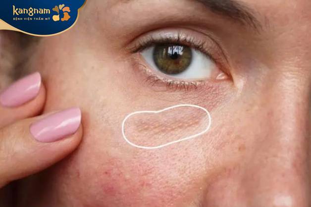 mụn thịt mọc ở dưới mắt thành từng cụm