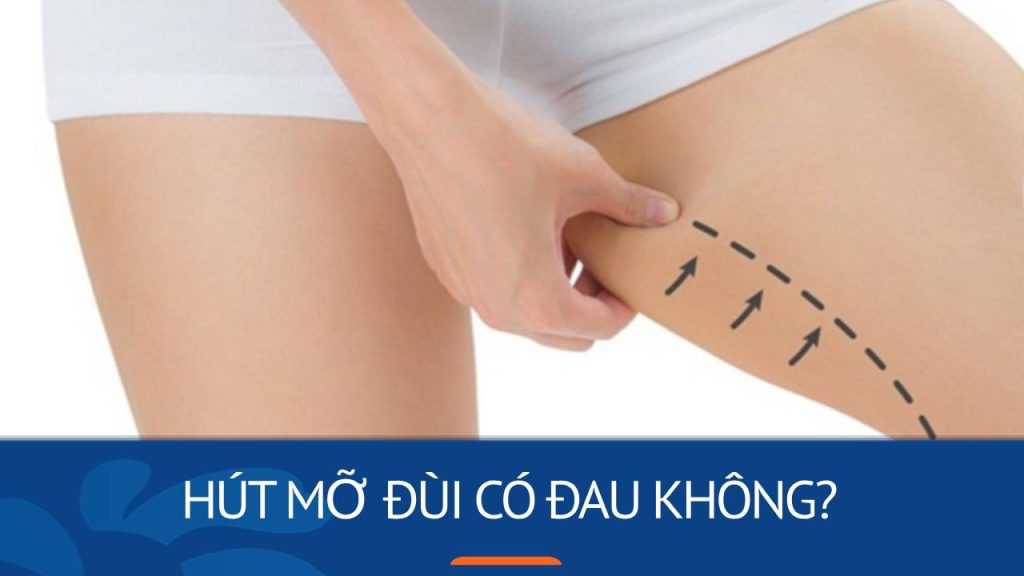 Hút mỡ đùi có đau không? Quy trình hút mỡ và lưu ý quan trọng