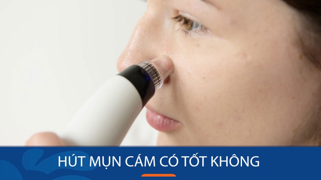 Hút mụn cám có tốt không – Giải Pháp Cho Làn Da Sạch Mịn?