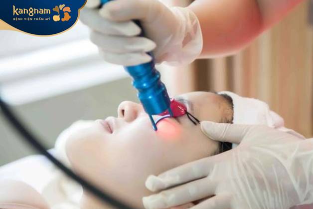 Công nghệ laser loại bỏ mụn thịt hiệu quả