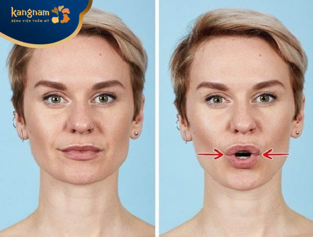 Vận động cơ miệng thường xuyên để botox tan nhanh hơn