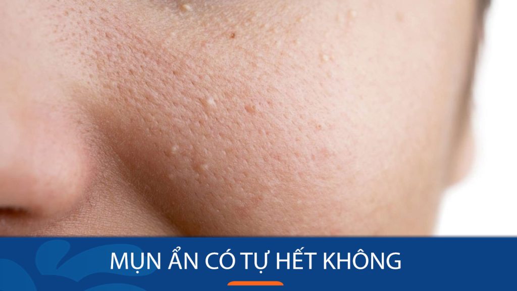 Mụn ẩn có tự hết không? Bí quyết “đánh bay” mụn ẩn