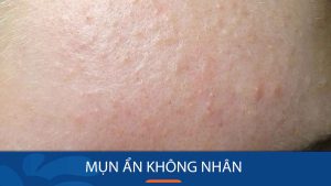 Mụn ẩn không nhân – Nỗi ám ảnh của làn da: Bí quyết NHANH CHÓNG lấy lại vẻ đẹp mịn màng