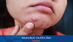 Lột tả nguyên nhân và cách trị mụn bọc dưới cằm hiệu quả, không lo tái phát