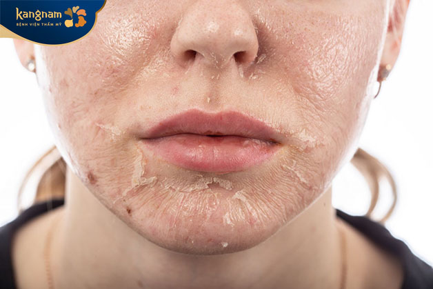 Phương pháp peel da sẽ loại bỏ lớp sừng già cỗi mang đến giúp loại bỏ mụn bọc và da mềm mịn hơn 