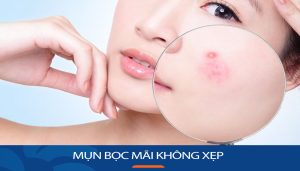 Mụn bọc mãi không xẹp? Đọc ngay bí quyết “đánh bay” mụn trong 1 nốt nhạc!