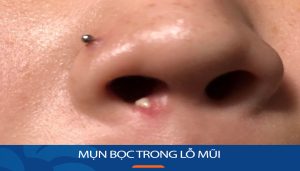 Bật mí bí quyết loại bỏ mụn bọc trong lỗ mũi an toàn và dứt điểm