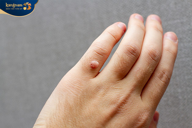 Mụn cóc ở tay là bệnh lý da liễu không nguy hiểm sức khỏe 