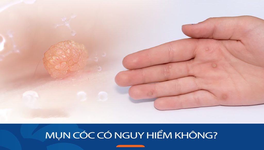 Mụn cóc có nguy hiểm không? Cách điều trị dứt điểm