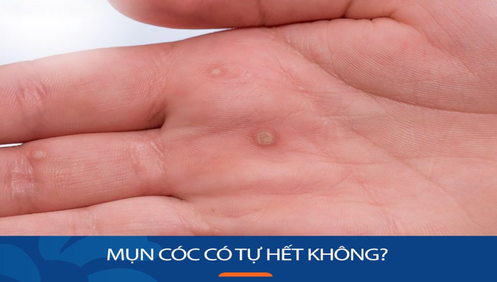 Mụn cóc có tự hết không? Cách điều trị hiệu quả, an toàn tại nhà
