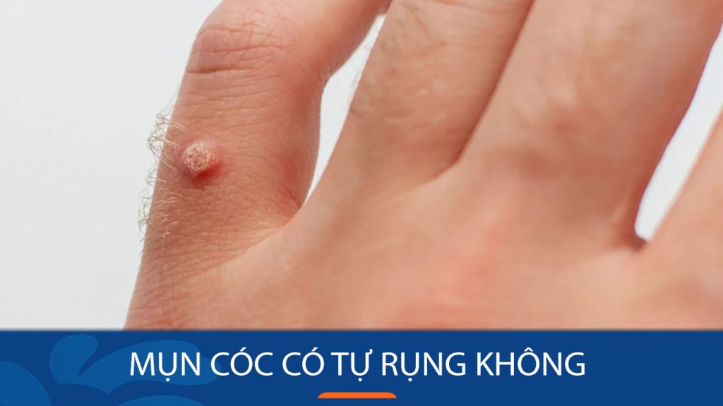 Mụn cóc có tự rụng? Bí quyết loại bỏ mụn cóc nhanh trong 1 tuần