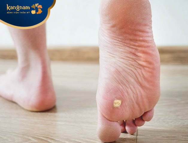 Mụn cóc mọc tại vị trí nhạy cảm ở bàn chân, ảnh hưởng đến chức năng vận động