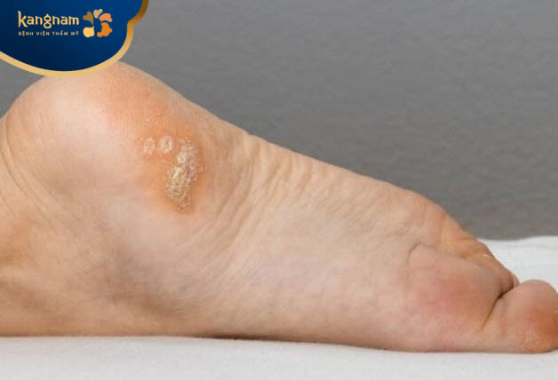 Nhiều nốt mụn cóc cùng một lúc dưới lòng bàn chân
