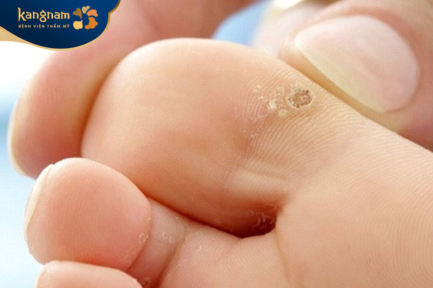 Mụn cóc mọc ở vùng ngón chân thường biểu hiện dưới dạng mảng da cứng, tăng sừng, có màu trắng